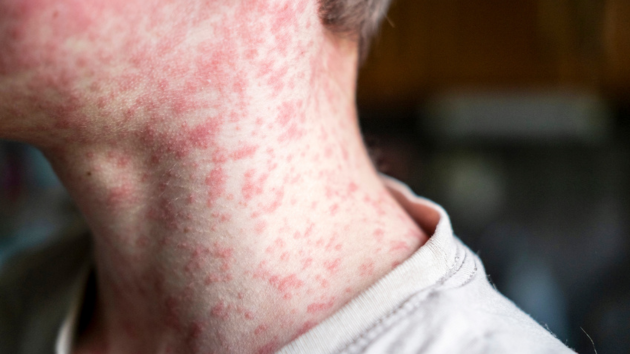 What to know about measles